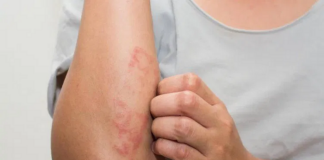 Realiza SSO acciones intensivas para erradicar la lepra