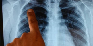 Descifran el genoma de 38 tipos de cáncer en busca de curas