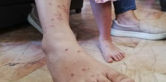 Disminuyen casos de varicela en la entidad en un 11%: SSO