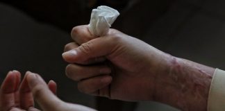 CNDH atrae caso de saxofonista atacada con ácido en Oaxaca