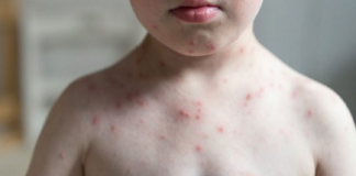 Aumentan a 26 los casos de sarampión en la CDMX; es más contagioso que el coronavirus