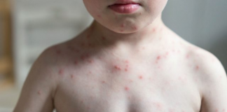 Confirman 4 casos de sarampión en CDMX; ninguno se vacunó