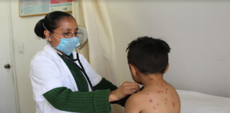 Cuantifica Oaxaca baja incidencia de casos de varicela: SSO