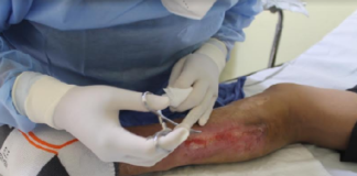 Clínica de heridas y ostomías de los SSO, cumple una década