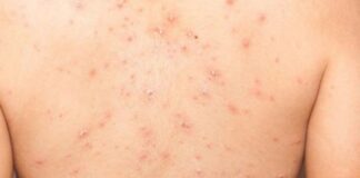 Reportan primer caso de viruela símica en Massachusetts, Estados Unidos