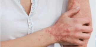 Riesgo de contagio del viruela de mono es muy bajo: expertos