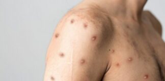 Emiten alerta sanitaria en México para detectar casos de viruela del mono