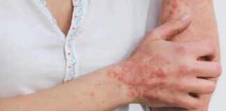 Detectan en Vallarta caso de viruela del mono; paciente escapó