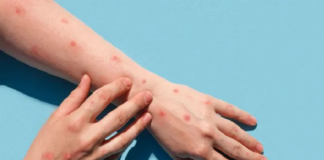 Viruela del mono: Confirman segundo caso en la CDMX