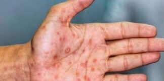 OMS convoca reunión de emergencia por brote de viruela del mono