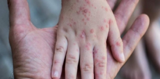 Viruela del Mono en México: Van 60 casos confirmados