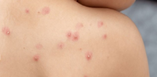 Hay 147 contagios confirmados de viruela símica en 18 estados