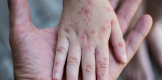 Reporta Oaxaca 7 casos de viruela del mono