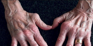 Recomienda IMSS Oaxaca acciones para prevenir artritis reumatoide