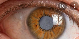 Realizará IMSS Jornada Quirúrgica de Oftalmología en Hospital de Matías Romero