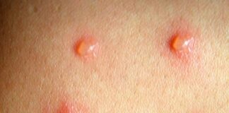 Insta SSO medidas de higiene para evitar casos de varicela