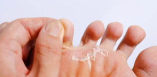 Recomienda IMSS medidas para evitar contagio de hongos durante vacaciones y temporada de lluvias